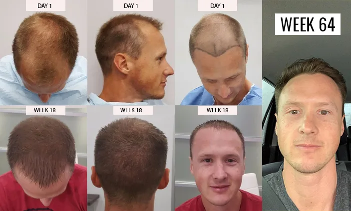 Mexico hair transplant clinics, compare the best options and prices now.