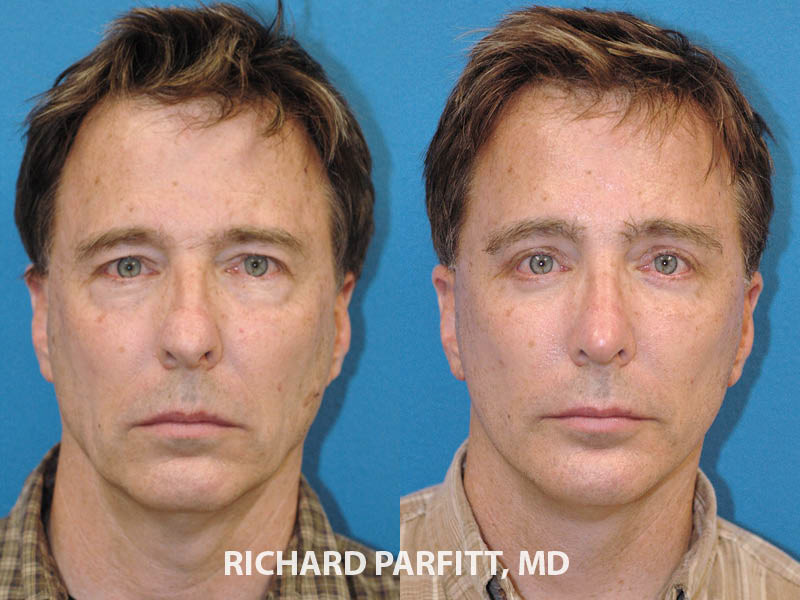 Forehead Lift Before and After Photos: Real People, Real Results!
