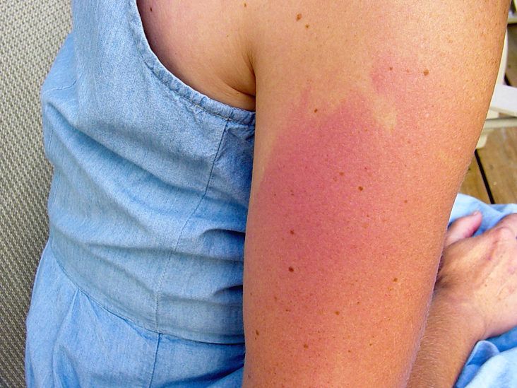 Itching After Tanning Bed? (Heres Why It Happens and What to Do!)