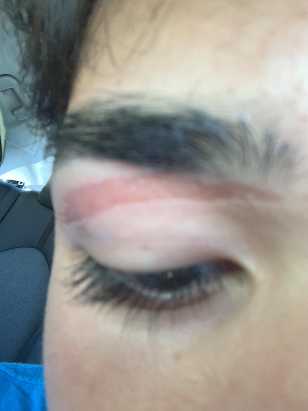 Accidentally Ripped Off Eyebrow Skin When Tweezing, Dont Panic, Try This!