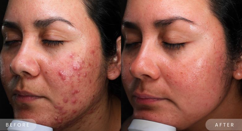Microdosing Accutane: Whats the Real Deal With Low-Dose Acne Treatment