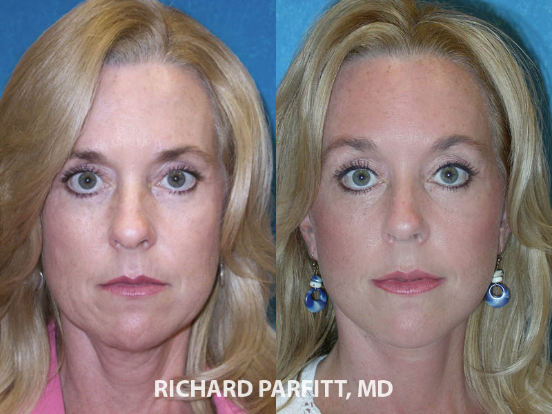 Forehead Lift Before and After Photos: Real People, Real Results!