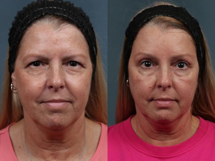 Forehead Lift Before and After Photos: Real People, Real Results!
