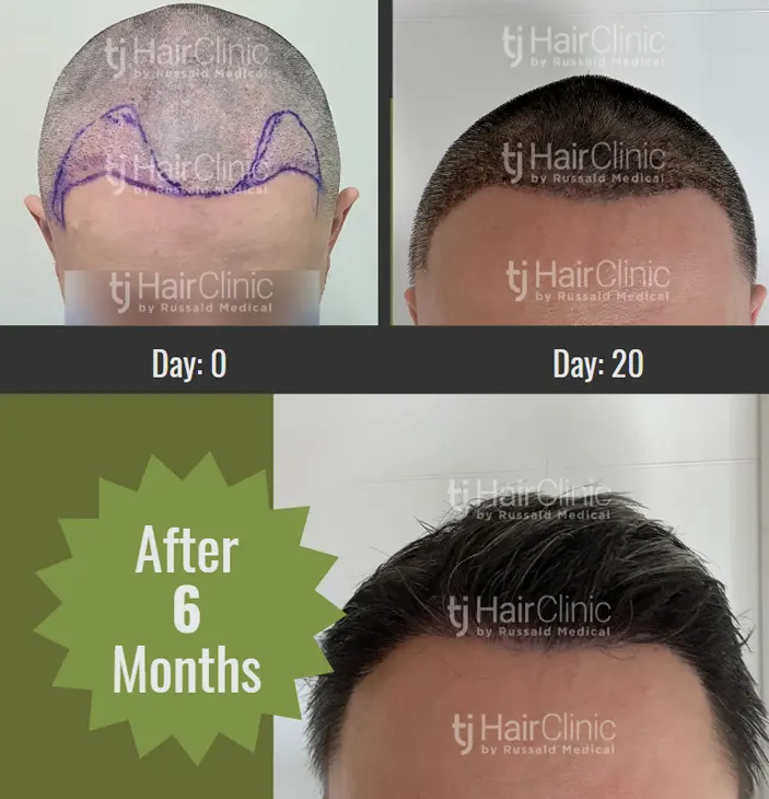 Mexico hair transplant clinics, compare the best options and prices now.