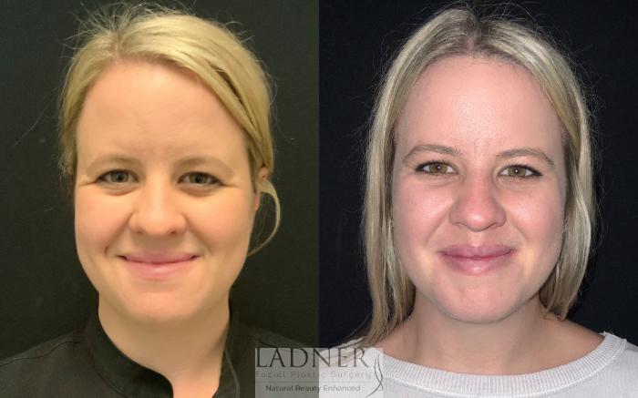 Forehead Lift Before and After Photos: Real People, Real Results!
