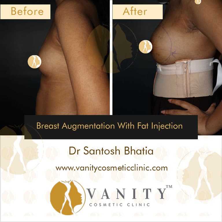 How to Get Perfect Big Breasts: Natural Ways and Surgery Options