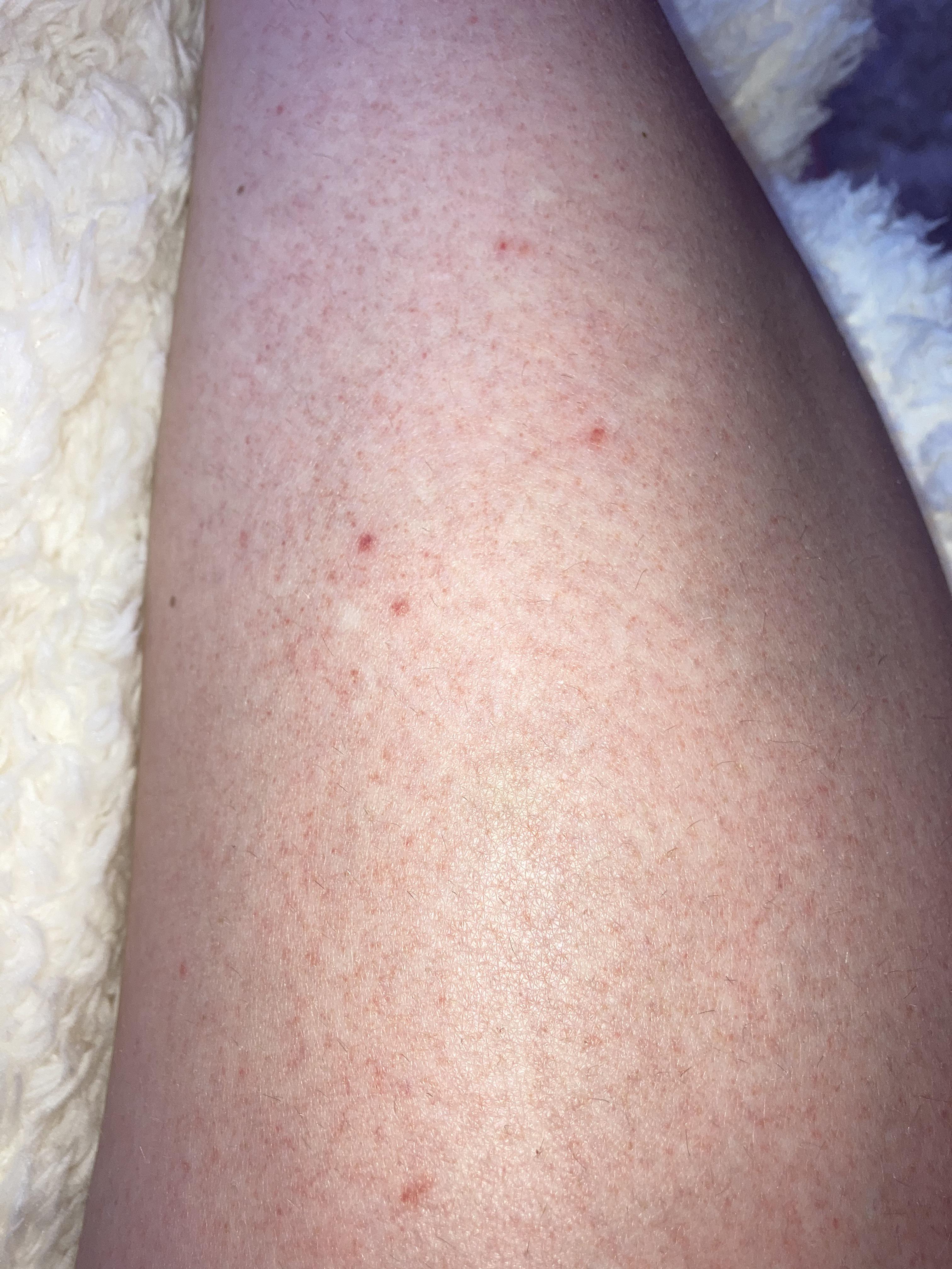 Itching After Tanning Bed? (Heres Why It Happens and What to Do!)